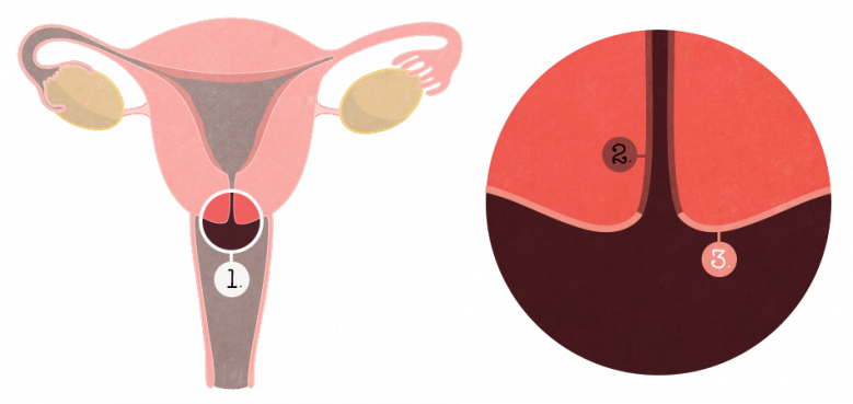 Schéma de l'appareil urogénital dit féminin avec les trompes et les ovaires, le vagin, l'utérus, et le col de l'utérus qui fait la jonction entre ces deux derniers. Une loupe zoome sur la différence entre l'exocol (partie du col présente dans le vagin et l'endocol, partie interne dans l'utérus).